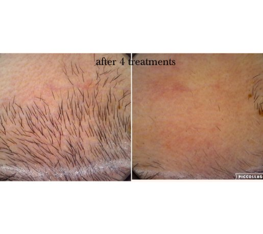 EpilMe before after - po 4 zabiegach