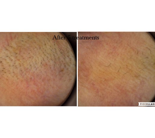 EpilMe before after - po 5 zabiegach