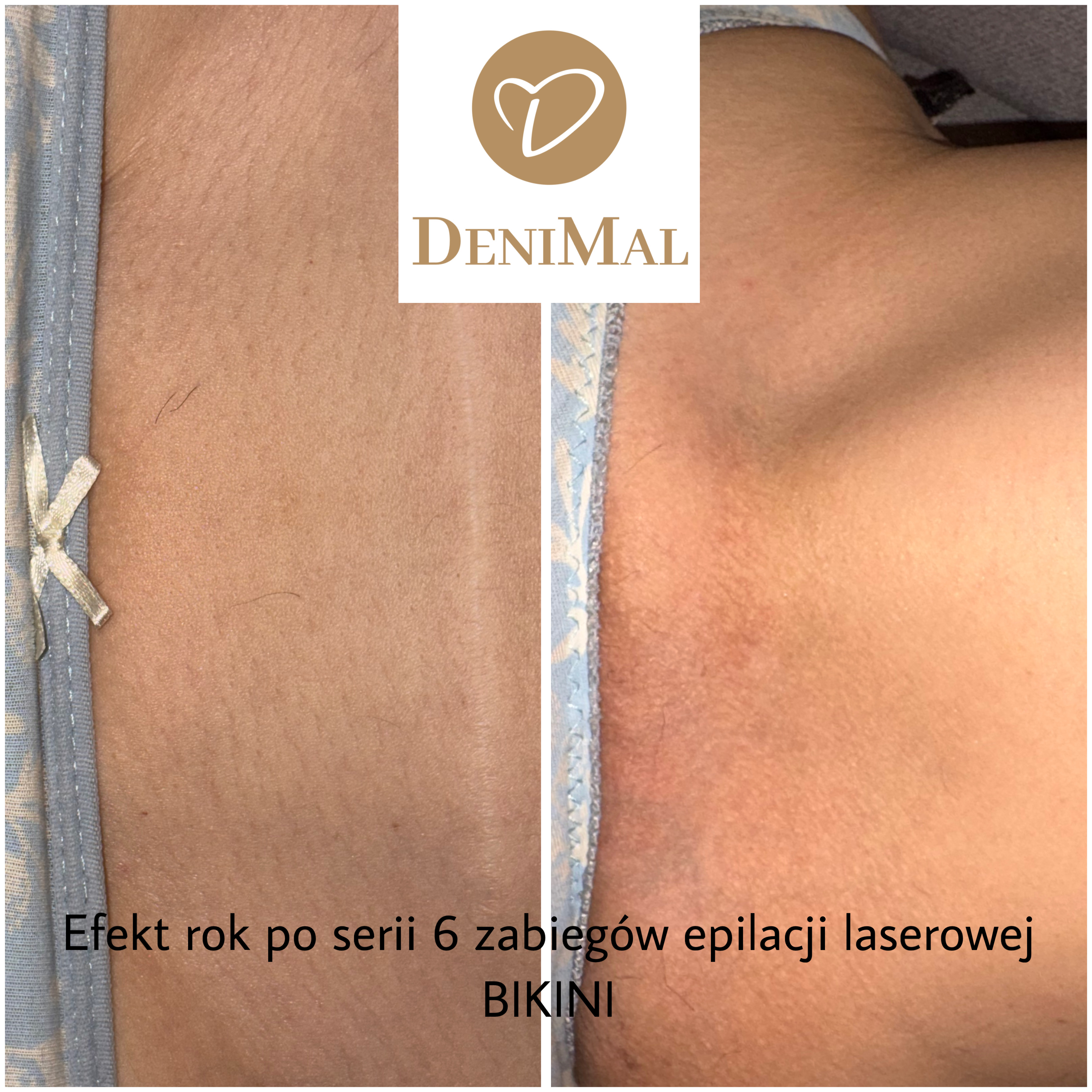 Efekty epilacji laserowej EpilMe - bikini
