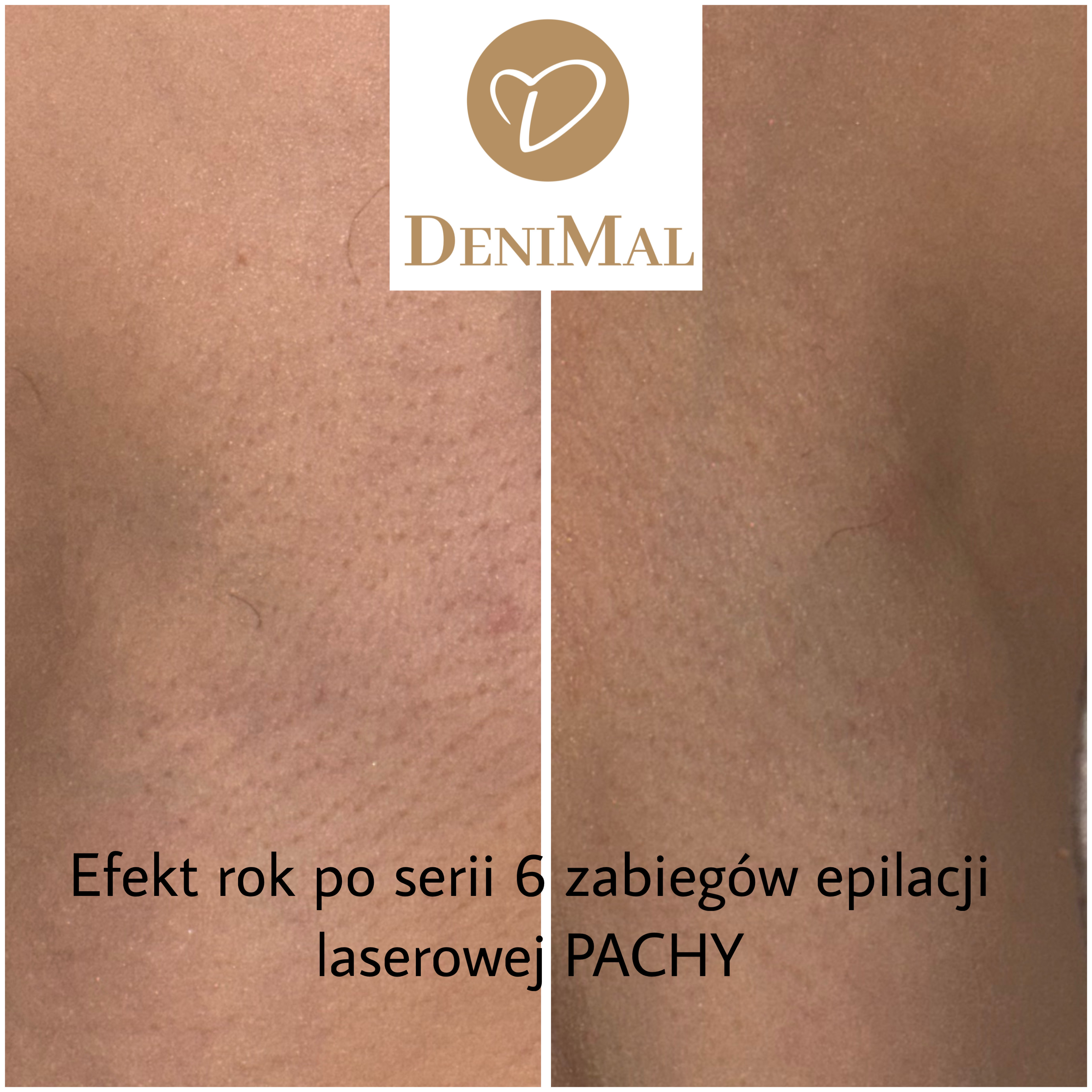 Efekty epilacji laserowej EpilMe - pachy