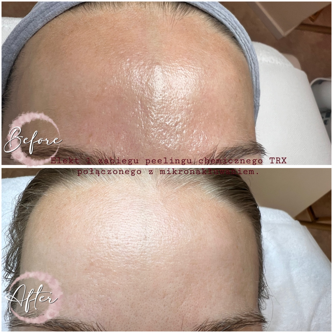 Efekt peelingu Melases TCA TRX — czoło