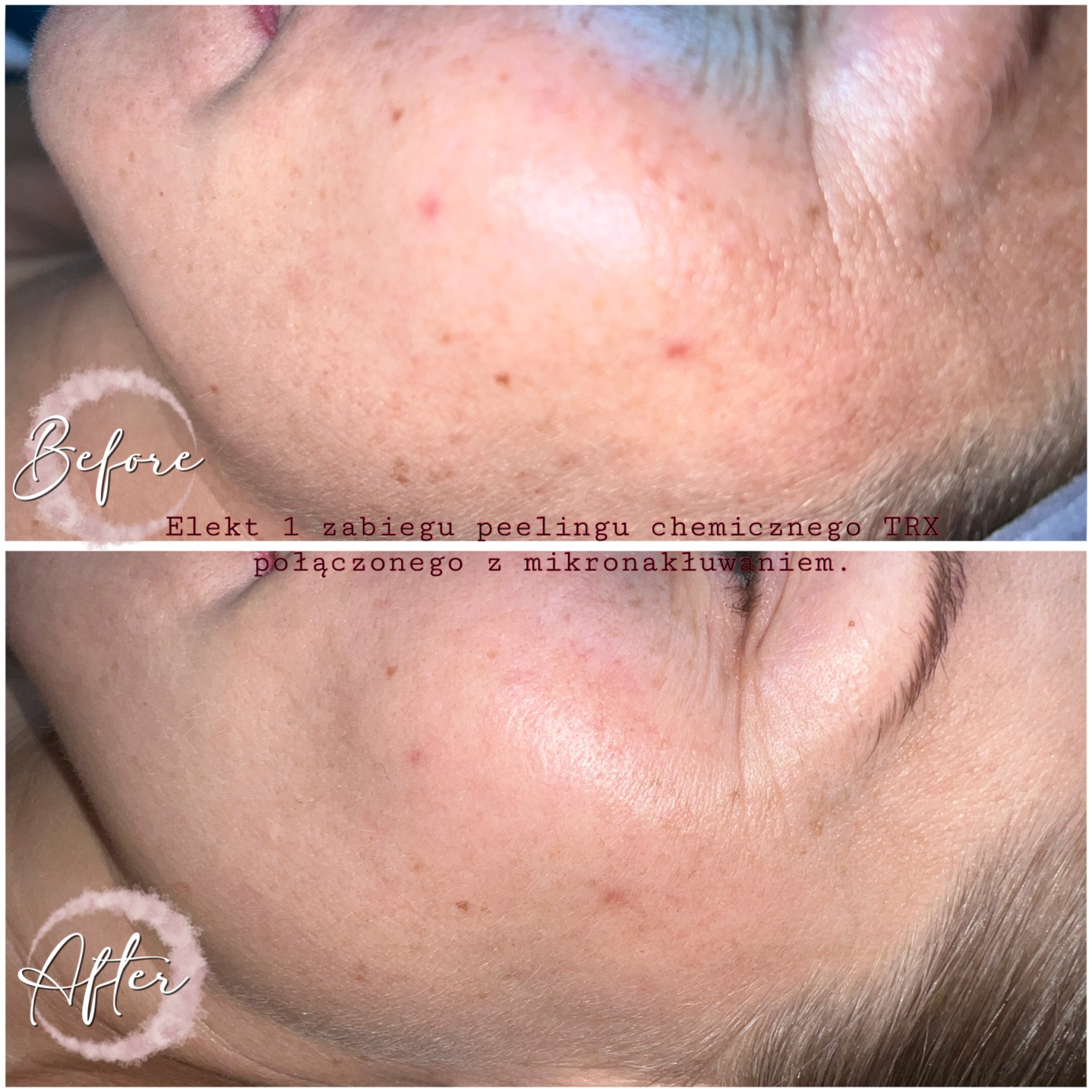 Efekt peelingu Melases TCA TRX — policzek