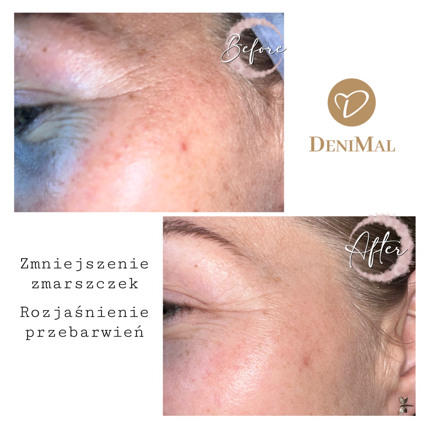 Efekt mikronakłuwania NANOPORE — zmniejszenie zmarszczek i rozjaśnienie